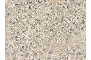 ABIN6263875 and ABIN6272705 at 1/100 staining human hepatocellular carcinoma by IHC-P.