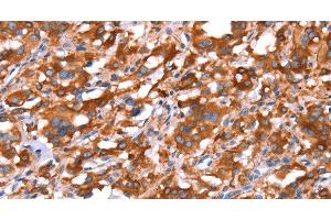 Immunohistochemistry of paraffin-embedded Human thyroid cancer tissue using GAS8 Polyclonal Antibody at dilution 1:40 (GAS8 anticorps)