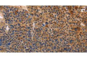 Immunohistochemistry of paraffin-embedded Human liver cancer tissue using MUSK Polyclonal Antibody at dilution of 1:30