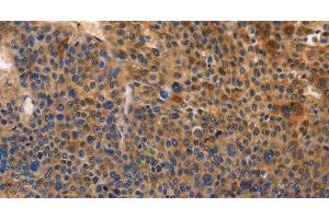 Immunohistochemistry of paraffin-embedded Human liver cancer tissue using MUSK Polyclonal Antibody at dilution of 1:30 (MUSK anticorps)