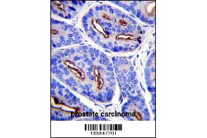 FOLH1 Antibody immunohistochemistry analysis in formalin fixed and paraffin embedded human prostate carcinoma followed by peroxidase conjugation of the secondary antibody and DAB staining. (PSMA anticorps  (N-Term))
