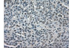 Immunohistochemical staining of paraffin-embedded Adenocarcinoma of breast tissue using anti-LDHA mouse monoclonal antibody. (Lactate Dehydrogenase A anticorps)