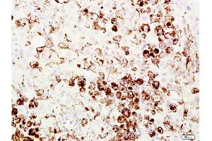 Formalin-fixed and paraffin embedded mouse melanoma labeled with Anti-Melanoma HMB45/Melanoma/Melan-A/MART-1 Polyclonal Antibody, Unconjugated  at 1:200 followed by conjugation to the secondary antibody and DAB staining. (MLANA anticorps  (AA 51-118))