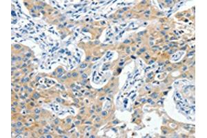 The image on the left is immunohistochemistry of paraffin-embedded Human lung cancer tissue using ABIN7190319(CNTNAP3 Antibody) at dilution 1/40, on the right is treated with synthetic peptide. (CNTNAP3 anticorps)