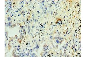 Immunohistochemistry of paraffin-embedded human lung cancer using ABIN7161904 at dilution of 1:100 (TR4 anticorps  (AA 240-380))