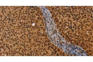 Immunohistochemistry of paraffin-embedded Human cervical cancer using CEL Polyclonal Antibody at dilution of 1:40