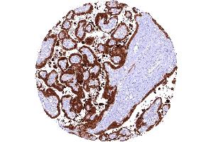 Placenta showing a strong cytoplasmic and nuclear PAI2 staining of trophoblast cells (Recombinant SERPINB2 anticorps)