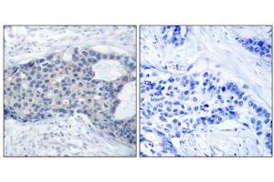 Immunohistochemical analysis of paraffin-embedded human breast carcinoma tissue using Zap-70(Phospho-Tyr493) Antibody(left) or the same antibody preincubated with blocking peptide(right). (ZAP7 (pTyr493) anticorps)