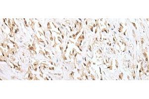 Immunohistochemistry of paraffin-embedded Human prost ate cancer tissue using ZNF34 Polyclonal Antibody at dilution of 1:40(x200) (ZNF34 anticorps)