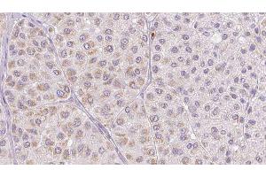 ABIN6277683 at 1/100 staining Human melanoma tissue by IHC-P. (PLAT anticorps  (C-Term))