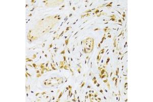 Immunohistochemistry of paraffin-embedded human gastric cancer using RPL13 Antibody (ABIN2559760) at dilution of 1:100 (40x lens). (RPL13 anticorps)