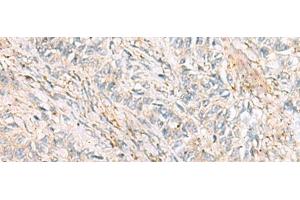 Immunohistochemistry of paraffin-embedded Human ovarian cancer tissue using HBZ Polyclonal Antibody at dilution of 1:120(x200)