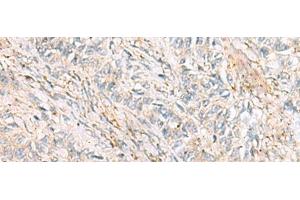 Immunohistochemistry of paraffin-embedded Human ovarian cancer tissue using HBZ Polyclonal Antibody at dilution of 1:120(x200) (HBZ anticorps)