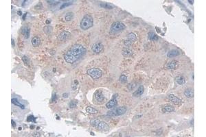 Detection of TACR2 in Human Breast cancer Tissue using Polyclonal Antibody to Tachykinin Receptor 2 (TACR2)