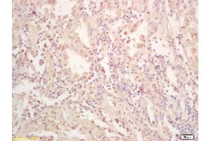 Formalin-fixed and paraffin embedded human gastric carcinoma labeled with Rabbit Anti FES Polyclonal Antibody, Unconjugated (ABIN714191) at 1:200 followed by conjugation to the secondary antibody and DAB staining (FES anticorps  (AA 121-220))