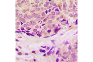 Immunohistochemical analysis of RPL37 staining in human breast cancer formalin fixed paraffin embedded tissue section.