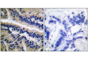 Immunohistochemical analysis of paraffin-embedded human lung carcinoma tissue, using Caspase 9 (cleaved-Asp353) antibody. (Caspase 9 anticorps  (Cleaved-Asp353))