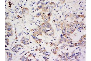 Formalin-fixed and paraffin embedded human breast carcinoma labeled with Anti-ZNF703 Polyclonal Antibody, Unconjugated  at 1:500 followed by conjugation to the secondary antibody and DAB staining. (ZNF703 anticorps  (AA 221-320))