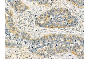 ASAP1 Mouse Monoclonal Antibody at 1/100 staining human lung cancer and adjacent non-tumor tissue by IHC-P.