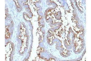 Formalin-fixed, paraffin-embedded human Prostate Carcinoma stained with CD73 Mouse Monoclonal Antibody (NT5E/2545).