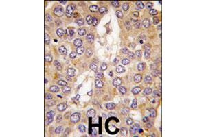 Formalin-fixed and paraffin-embedded human hepatocellular carcinoma reacted with CSNK1G2 polyclonal antibody  , which was peroxidase-conjugated to the secondary antibody, followed by DAB staining. (Casein Kinase 1 gamma 2 anticorps  (C-Term))