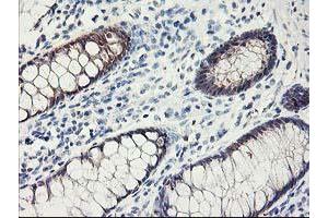 Immunohistochemical staining of paraffin-embedded Human colon tissue using anti-FABP2 mouse monoclonal antibody. (FABP2 anticorps)