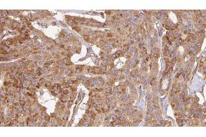 ABIN6267112 at 1/100 staining Human thyroid cancer tissue by IHC-P. (Doublecortin anticorps  (pSer297))