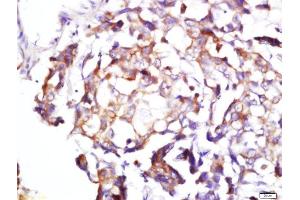 Formalin-fixed and paraffin embedded human lung cancer labeled with Rabbit Anti-BDKRB1 Polyclonal Antibody, Unconjugated  at 1:200 followed by conjugation to the secondary antibody and DAB staining (BDKRB1 anticorps  (AA 161-260))