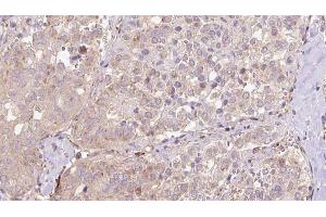 ABIN6273319 at 1/100 staining Human thyroid cancer tissue by IHC-P. (SLC13A2 anticorps)