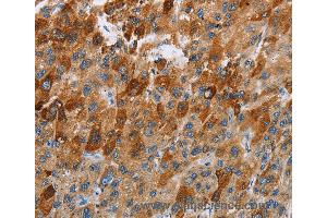 Immunohistochemistry of Human thyroid cancer using CCR9 Polyclonal Antibody at dilution of 1:40