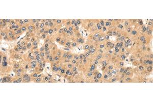 Immunohistochemistry of paraffin-embedded Human liver cancer using TTC23 Polyclonal Antibody at dilution of 1/35 (TTC23 anticorps)