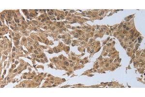 Immunohistochemistry of paraffin-embedded Human cervical cancer using PSMD6 Polyclonal Antibody at dilution of 1:40 (PSMD6 anticorps)