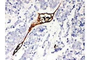 IHC-P: Mesothelin antibody testing of human lung cancer tissue (Mesothelin anticorps  (AA 306-576))