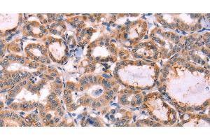 Immunohistochemistry of paraffin-embedded Human thyroid cancer tissue using PROS1 Polyclonal Antibody at dilution 1:60 (PROS1 anticorps)