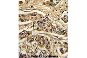 Formalin-fixed and paraffin-embedded human breast carcinomareacted with FREQ polyclonal antibody , which was peroxidase-conjugated to the secondary antibody, followed by AEC staining. (NCS1 anticorps  (Internal Region))
