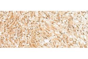 Immunohistochemistry of paraffin-embedded Human liver cancer tissue using RBM19 Polyclonal Antibody at dilution of 1:45(x200) (RBM19 anticorps)