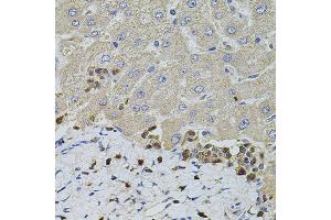 Immunohistochemistry of paraffin-embedded human liver injury using S100A12 antibody (ABIN1876516) at dilution of 1:100 (40x lens). (S100A12 anticorps)