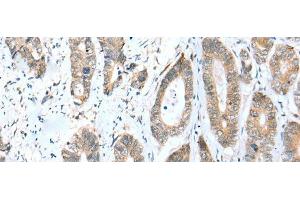 Immunohistochemistry of paraffin-embedded Human gastric cancer tissue using ACBD4 Polyclonal Antibody at dilution of 1:30(x200) (ACBD4 anticorps)