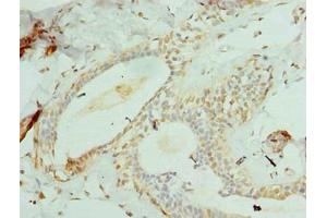 Immunohistochemistry of paraffin-embedded human breast cancer using ABIN7148180 at dilution of 1:100 (CCDC97 anticorps  (AA 1-343))