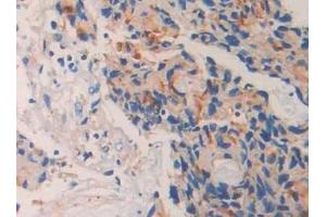 Detection of CD10 in Human Prostate cancer Tissue using Polyclonal Antibody to Neprilysin (CD10)