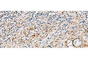 Immunohistochemistry of paraffin-embedded Human cervical cancer tissue using TMEM141 Polyclonal Antibody at dilution of 1:60(x200) (TMEM141 anticorps)