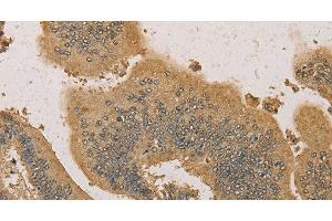 Immunohistochemistry of paraffin-embedded Human colon cancer tissue using PRDM14 Polyclonal Antibody at dilution 1:30 (PRDM14 anticorps)