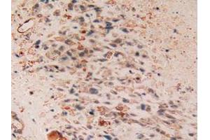 IHC-P analysis of Human Lung Cancer Tissue, with DAB staining. (Cytokeratin 7 anticorps  (AA 91-394))