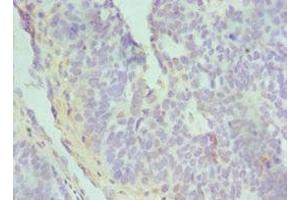 Immunohistochemistry of paraffin-embedded human endometrial cancer using ABIN7172842 at dilution of 1:100