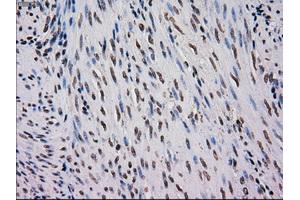 Immunohistochemical staining of paraffin-embedded Carcinoma of kidney tissue using anti-MRI1mouse monoclonal antibody. (MRI1 anticorps)