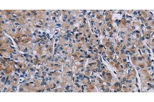Immunohistochemistry of paraffin-embedded Human prostate cancer using KDM4D Polyclonal Antibody at dilution of 1:50 (JMJD2D anticorps)