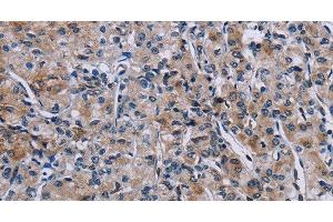 Immunohistochemistry of paraffin-embedded Human prostate cancer using KDM4D Polyclonal Antibody at dilution of 1:50