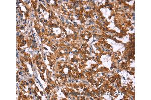 Immunohistochemistry of Human gastric cancer using HACE1 Polyclonal Antibody at dilution of 1:40