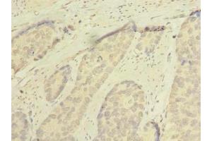 Immunohistochemistry of paraffin-embedded human gastric cancer using ABIN7168953 at dilution of 1:100 (C7orf45 anticorps  (AA 56-244))