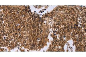 Immunohistochemistry of paraffin-embedded Human cervical cancer tissue using ERCC6L Polyclonal Antibody at dilution 1:30 (ERCC6L anticorps)